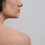 A close-up image of the skin of a woman with acne and other face and body acne.